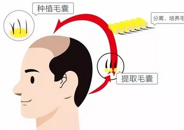 济南中心医院秃顶植发需要多少钱?怎样选择靠谱的植发医生!果怎么样?
