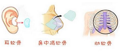 中山中医院美容科软骨隆鼻手术怎么样?做的自然吗?项目科普%医生推荐!