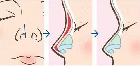 贺光照隆鼻怎么样?医生种草来袭!贺光照就很nice~