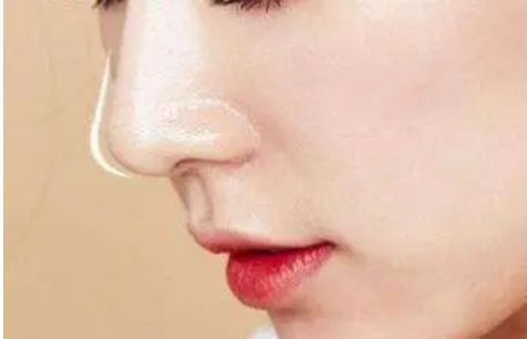 重医一附院张恒术案例如何?记录一下隆鼻手术的过程!快来了解一下扒吧!