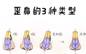 淮安二院整形科鼻子歪矫正多少钱?医疗美容医院少不了,附口碑明细一览!