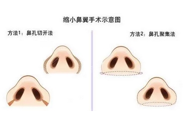 杭州117医院整形科鼻头缩小要多少钱?医生信息、案例介绍!盘点一家正规医院~