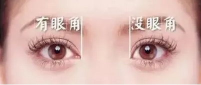 开眼角有风险吗?术前一定要知道其利弊,优缺点!开眼角手术术后怎么护理?