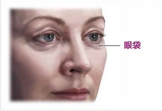 临淄区人民医院整形美容科手术去眼袋怎么样?去完眼袋,眼睛会轻松不少!