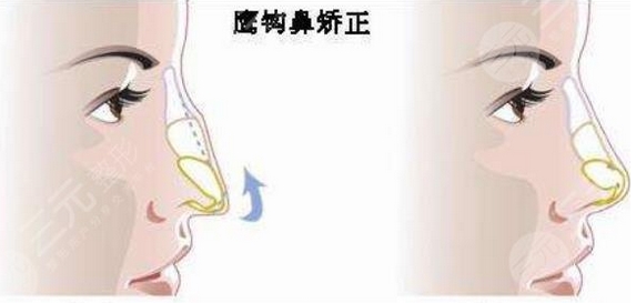怎样改变鹰钩鼻子?想做鼻综合!分享这个方法帮你解决问题!