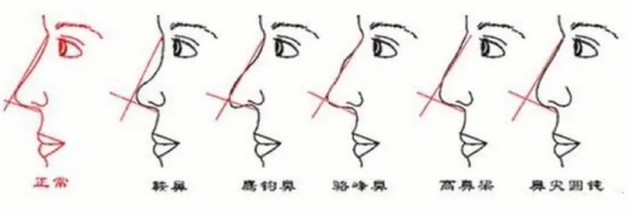 怎样改变鹰钩鼻子?想做鼻综合!分享这个方法帮你解决问题!