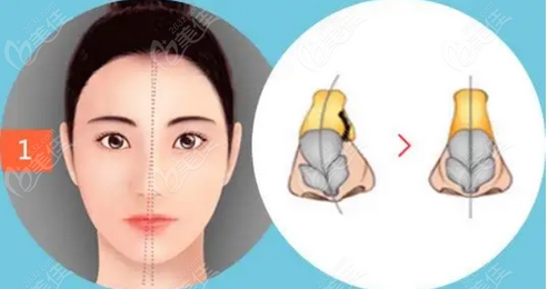 南大一附医院美容科歪鼻整形的价格如何?医生介绍!隆鼻体验怎么样?