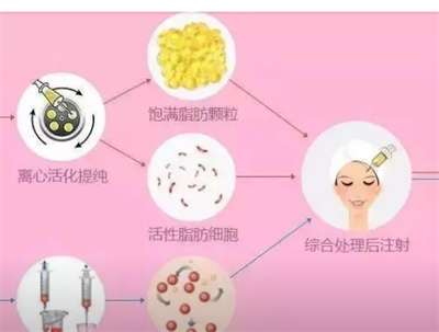 脂肪填充多久恢复好？自体脂肪填充护理小方法分享