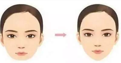 激光溶脂瘦脸恢复过程?真人叙述瘦脸经过~后前后对比照