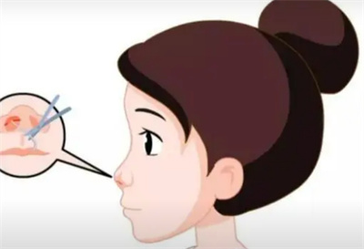 冷奎仿鼻子做的怎么样?医生技术测评~真人隆鼻案例