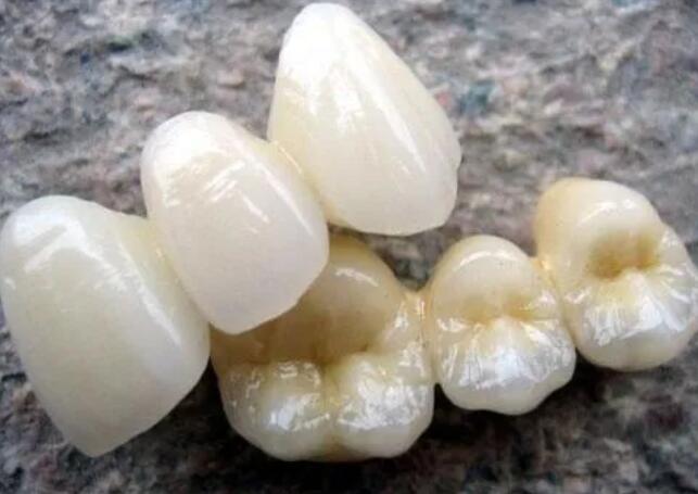 钛合金烤瓷牙的使用寿命是多久?效果怎么样?费用贵不贵?