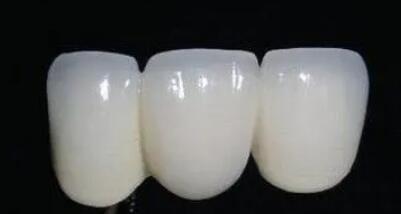 钛合金烤瓷牙的使用寿命是多久?效果怎么样?费用贵不贵?