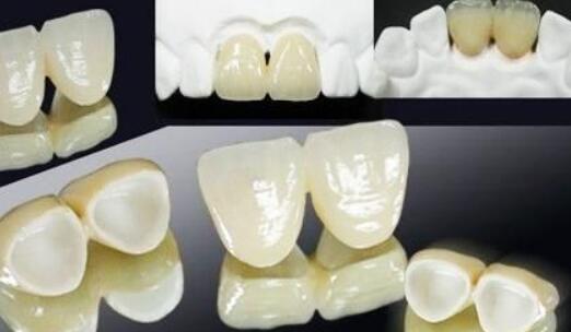 钛合金烤瓷牙的使用寿命是多久?效果怎么样?费用贵不贵?
