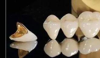 钛合金烤瓷牙的使用寿命是多久?效果怎么样?费用贵不贵?