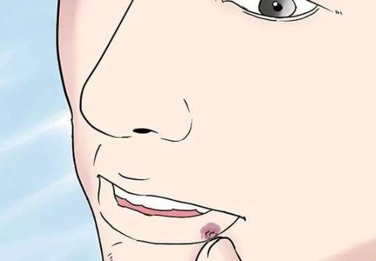 嘴唇上长水泡是什么原因?如何鉴别上火和疱疹?