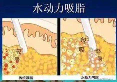 产后减肥人气方法是什么?水动力吸脂的步骤介绍!