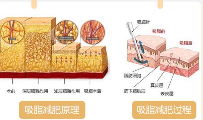 产后减肥人气方法是什么?水动力吸脂的步骤介绍!