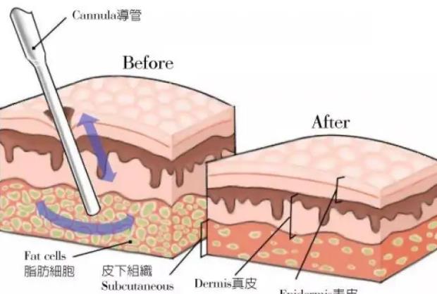 产后减肥人气方法是什么?水动力吸脂的步骤介绍!