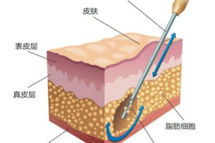 产后减肥人气方法是什么?水动力吸脂的步骤介绍!