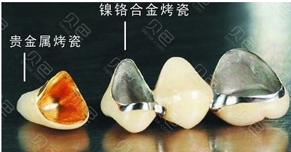 烤瓷牙价格和种类有哪些?价格贵吗?怎么种牙不花冤枉钱!