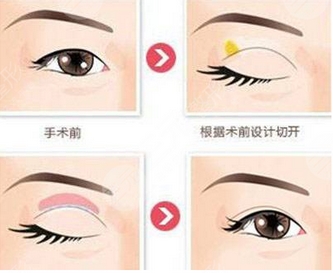 苏薇洁双眼皮案例图!妙手造靓眼~附真人眼综合案例信息!