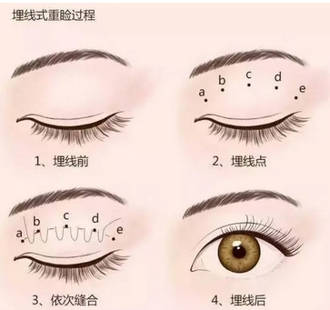 协和医院朱琳双眼皮案例如何?医生怎么样?简介公开,双眼皮案例测评!