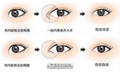 张冰洁修复内眼角案例公开!帮您解除关于内眼角的各种疑虑!
