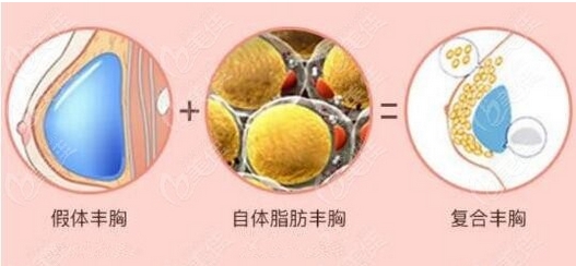 八大处刘春军脂肪隆胸价格如何?隆胸技术好口碑赞!附案例分享~