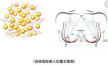 八大处刘春军脂肪隆胸价格如何?隆胸技术好口碑赞!附案例分享~