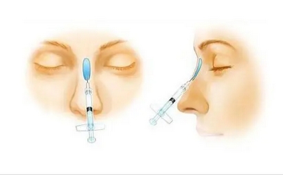 伊维兰注射隆鼻多久见果?有没有永久性的?还可以做假体隆鼻可以吗?