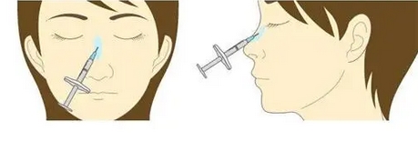 伊维兰注射隆鼻多久见果?有没有永久性的?还可以做假体隆鼻可以吗?