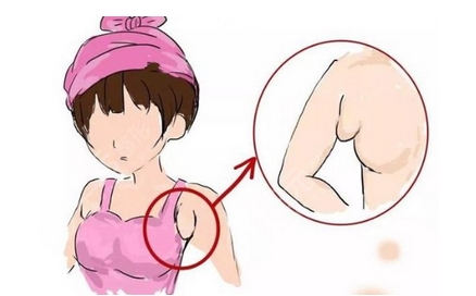协和医院朱琳副乳手术风格如何?朱琳副乳手术案例分享!替夏天解决掉你的副乳~