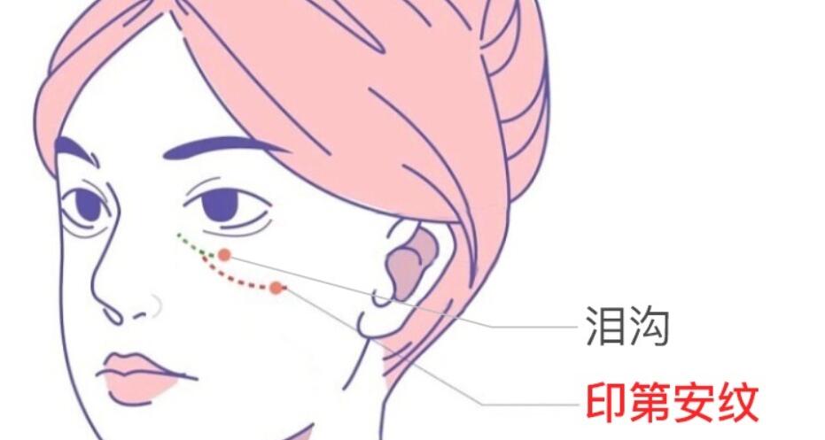 脂肪填充泪沟有哪些注意事项？费用大约是多少？