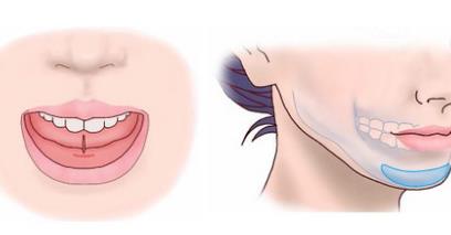 假体垫下巴贵吗?如何进行正确的护理?有哪些因素影响?