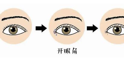 开内眼角好看吗?开眼角的优势以及注意事项有哪些?