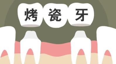 烤瓷牙做的不好会出现哪些症状，你了解多少？戳进来吧！
