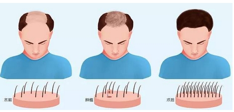 国内植发三大知名医院有哪些?实力技术双UP!北京、成都等都有上榜哦!