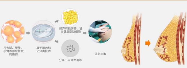 北京八大处刘春军做自体脂肪隆胸多少钱?隆胸技术好口碑赞~内附真实案例一览!