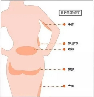 减肥吸脂多少钱?抽之后多久消肿?术后能管几年_恢复期需要多久!
