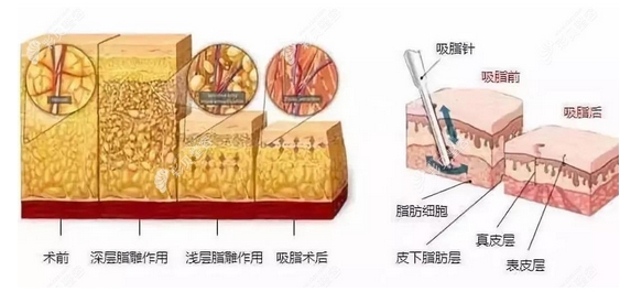 减肥吸脂多少钱?抽之后多久消肿?术后能管几年_恢复期需要多久!