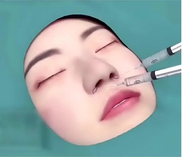 鼻翼缩小术大概需要多少钱?是永久的吗?术后注意事项也很重要!