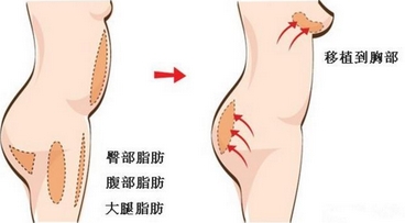 自体脂肪丰胸可以维持多长时间？丰胸后可以捏吗？脂肪胸好还是假体胸好呢？