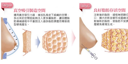 自体脂肪丰胸可以维持多长时间？丰胸后可以捏吗？脂肪胸好还是假体胸好呢？