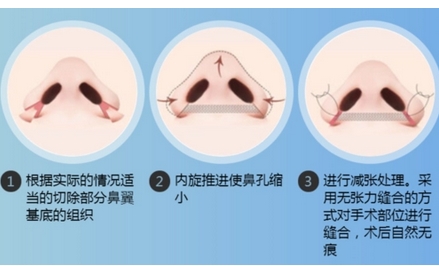 鼻翼缩小手术是永久的吗？只做鼻翼缩小有果吗？让我们的颜值无限上分~