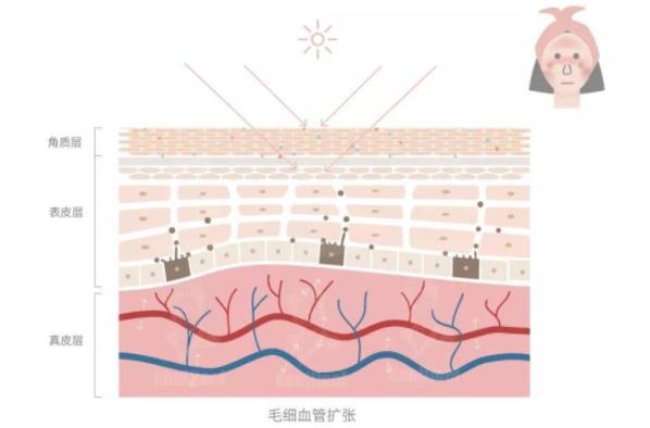 调节面部红血丝方法有哪些?光子嫩肤去红血丝的原理及优势介绍!
