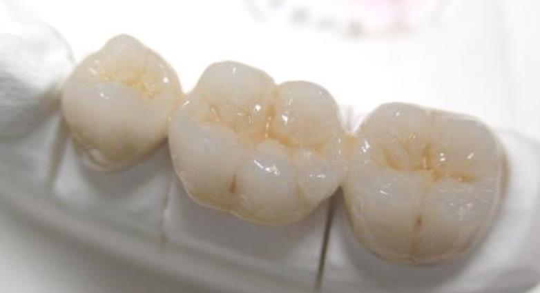 长春烤瓷牙多少钱？烤瓷牙一般可以使用多少年？优缺点介绍