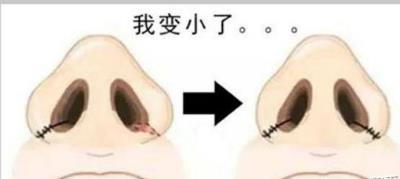 鼻翼缩小的方法，有几个你全了解吗？