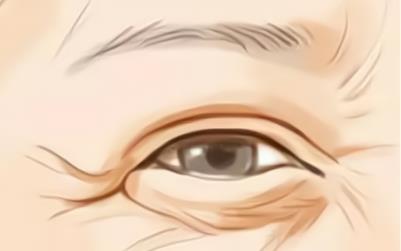 怎样消除眼部皱纹?你知道几各方式,可以进来了解!