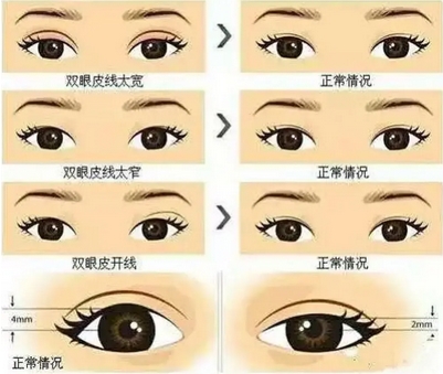 苏薇洁修复双眼皮厉害还是余东?更新出炉!眼综合包含哪些项目?