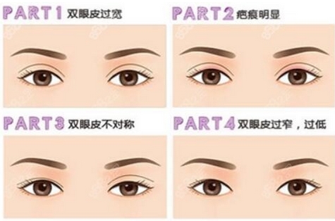 苏薇洁修复双眼皮厉害还是余东?更新出炉!眼综合包含哪些项目?